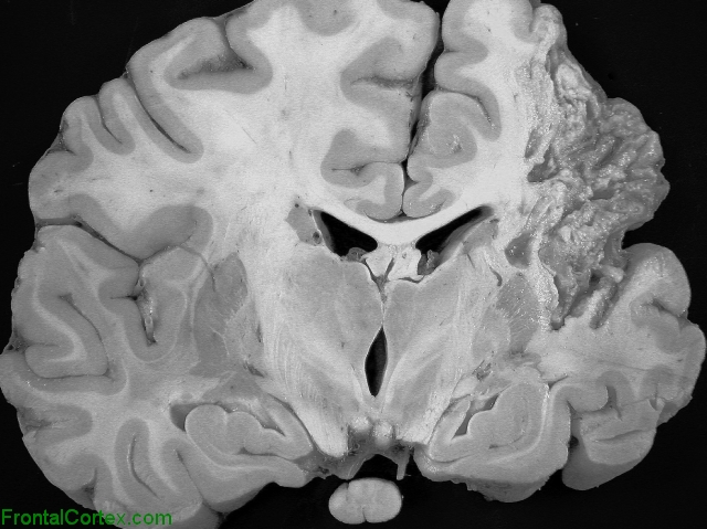 Organizing   Infarct, coronal section through thalamus with transverse section of spinal cord.